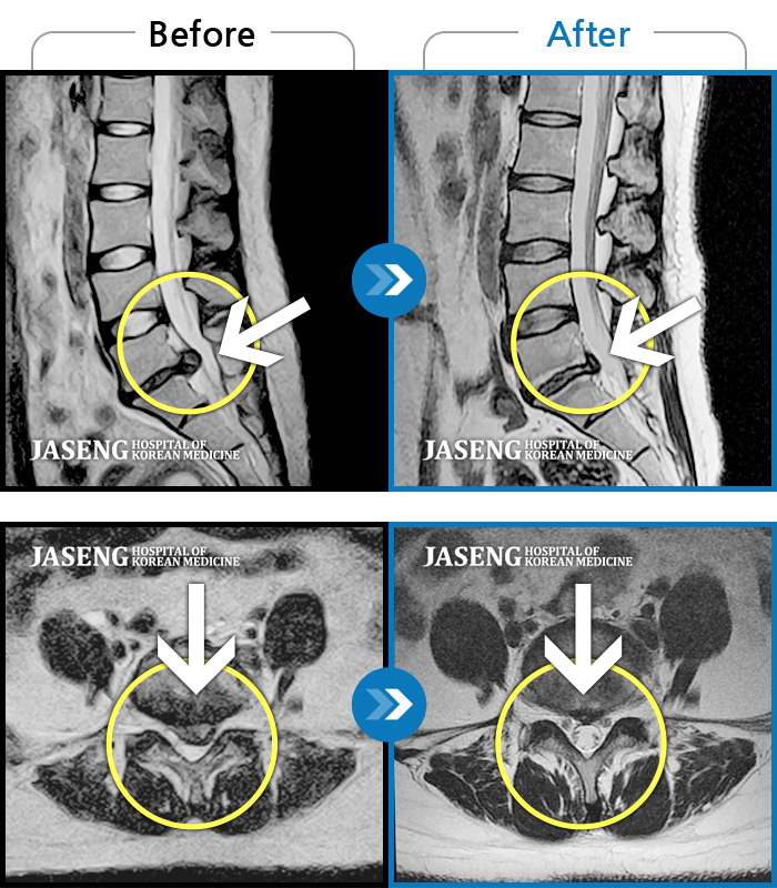 자생한방병원 치료사례 MRI로 보는 치료결과-좌측다리로 저리고 통증, 허리 숙일 때 다리 당김