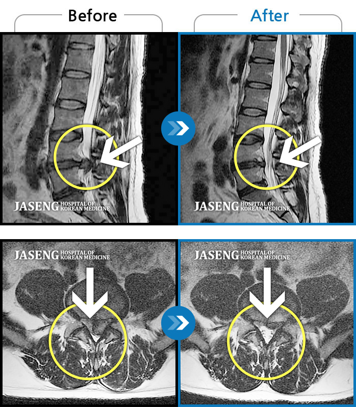 자생한방병원 치료사례 MRI로 보는 치료결과-허리 통증과 좌측 다리 마비 증상