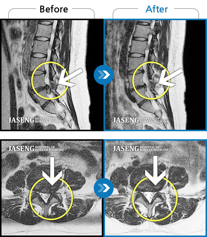 자생한방병원 치료사례 MRI로 보는 치료결과-급성허리통증으로 내원