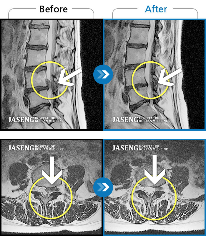 자생한방병원 치료사례 MRI로 보는 치료결과-허리통증과 좌측 하지방사통