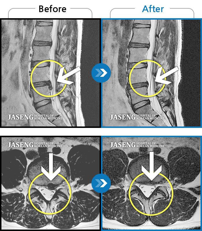 자생한방병원 치료사례 MRI로 보는 치료결과-허리와 다리 통증으로 입원