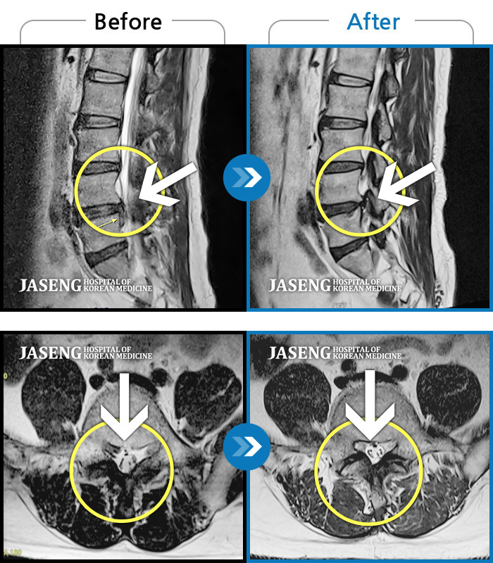 자생한방병원 치료사례 MRI로 보는 치료결과-허리 통증, 다리 근력 저하