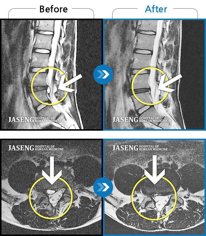 자생한방병원 치료사례 MRI로 보는 치료결과-오른쪽 허리 골반 통증, 보행시 우측 다리까지 통증 및 당김 증상
