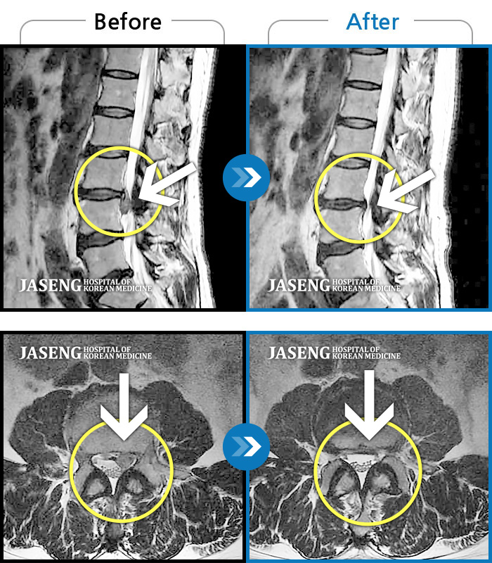 자생한방병원 치료사례 MRI로 보는 치료결과-좌측 허리 통증 및 좌측 허벅지, 정강이의 통증과 저림, 감각근력저하