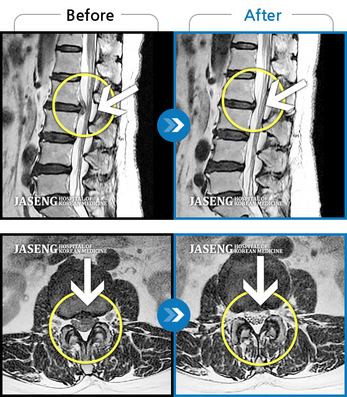 자생한방병원 치료사례 MRI로 보는 치료결과-허리디스크로 인한 허리통증