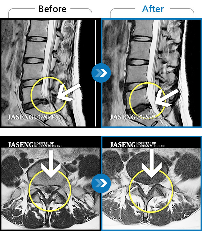 자생한방병원 치료사례 MRI로 보는 치료결과-보행 시 통증 및 좌측 다리 통증