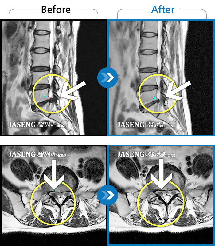 자생한방병원 치료사례 MRI로 보는 치료결과-좌측 허리 통증과 좌측 다리 저림 