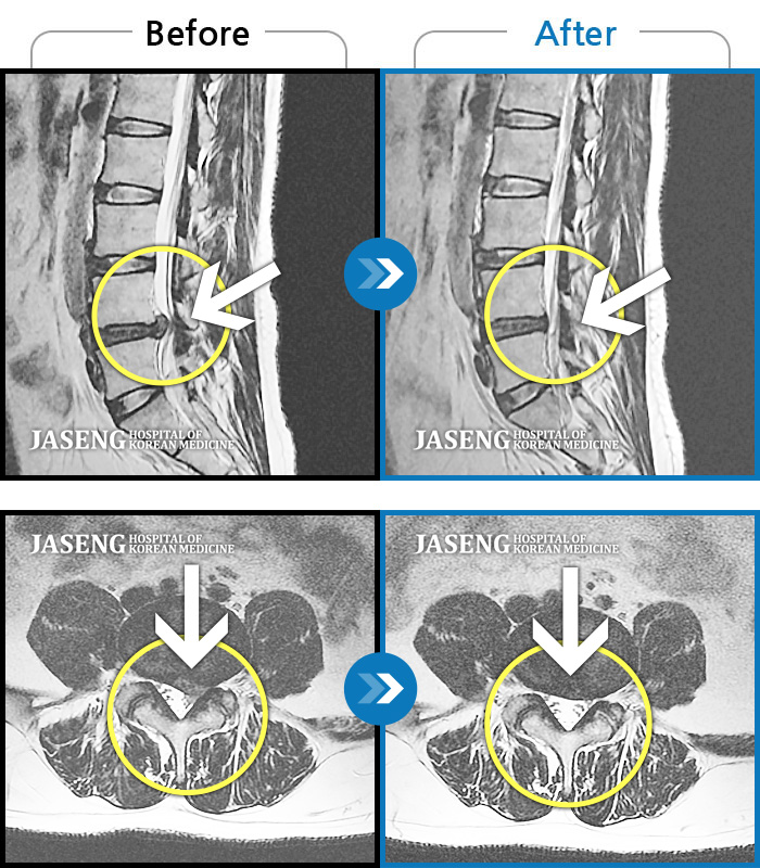 자생한방병원 치료사례 MRI로 보는 치료결과-양쪽 허리와 골반 통증, 걸을 때 좌측 다리가 당기고 아픔