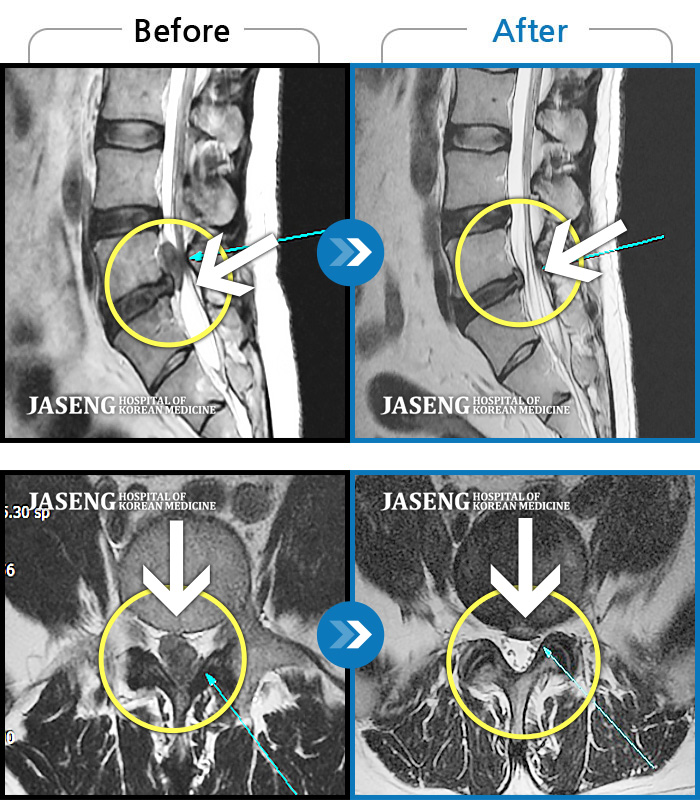 자생한방병원 치료사례 MRI로 보는 치료결과-허리통증과 좌측 엉덩이에서 다리까지 방사통, 야간통
