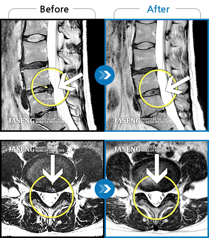 자생한방병원 치료사례 MRI로 보는 치료결과-허리통증, 왼쪽 다리 저림 및 통증