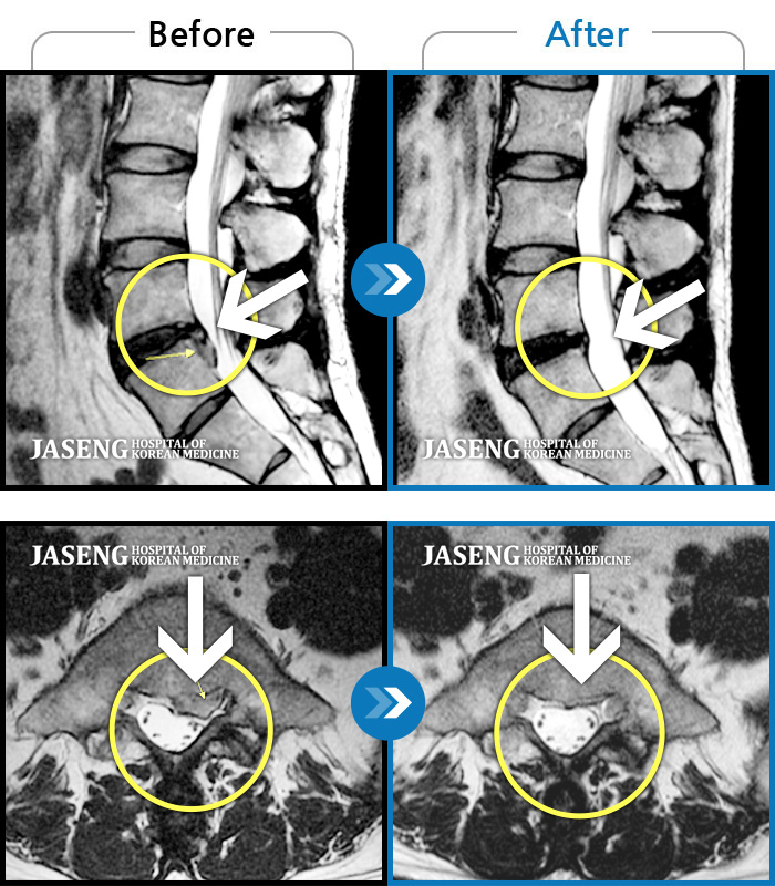 자생한방병원 치료사례 MRI로 보는 치료결과-허리통증, 왼쪽 다리 통증 및 근력 저하
