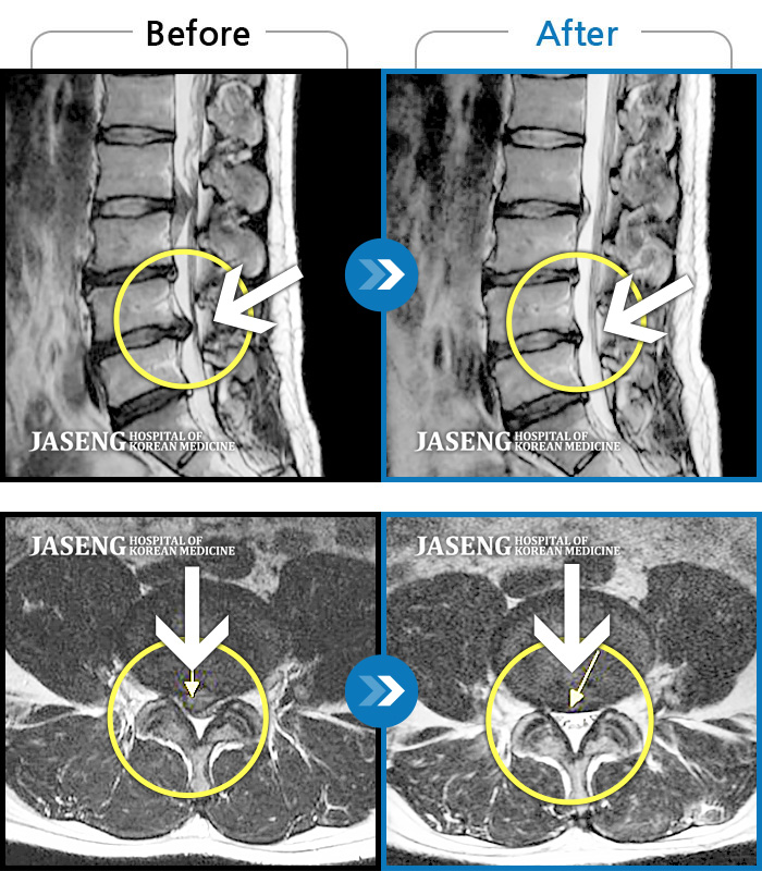자생한방병원 치료사례 MRI로 보는 치료결과-허리와 골반 통증, 누워서 다리를 움직일 때 통증 발생