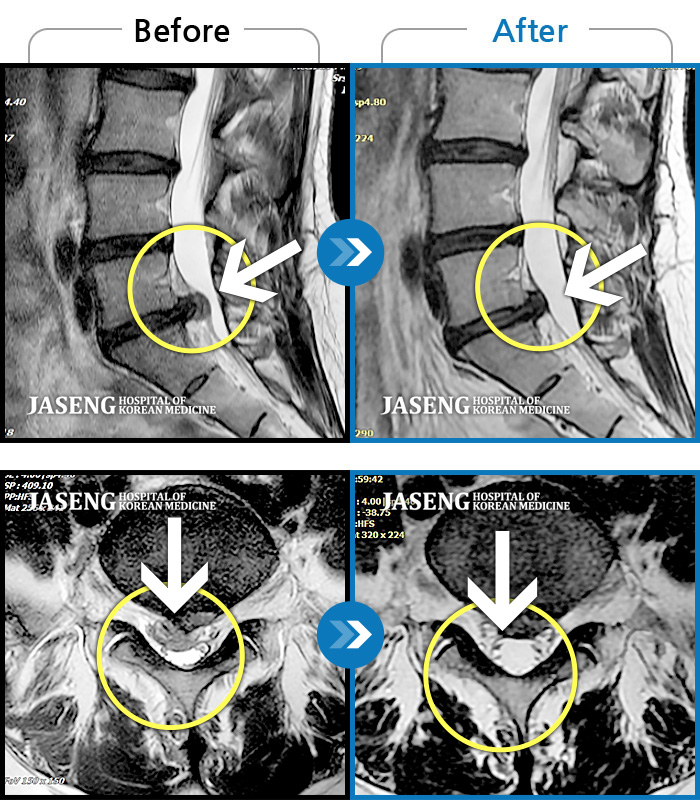 자생한방병원 치료사례 MRI로 보는 치료결과-우측 허리와 골반 통증, 우측 다리에 통증과 저림