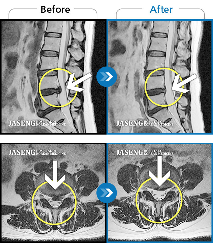 자생한방병원 치료사례 MRI로 보는 치료결과-좌측 다리 측면의 통증으로 입원