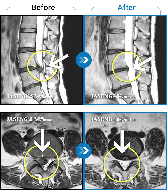 자생한방병원 치료사례 MRI로 보는 치료결과-허리통증, 우측 다리 저림과 근력, 감각 저하 및 통증으로 내원