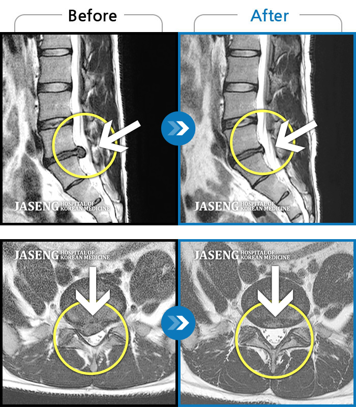 자생한방병원 치료사례 MRI로 보는 치료결과-허리와 다리에 찌르는 듯한 통증