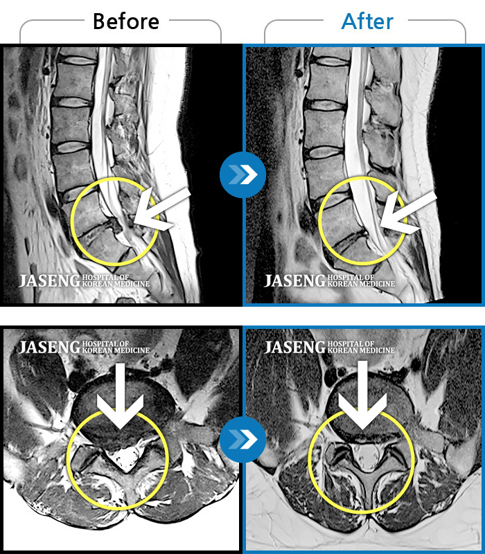 자생한방병원 치료사례 MRI로 보는 치료결과-서서 움직일 때, 앉았다 일어날 때 허리 및 우측 다리 통증