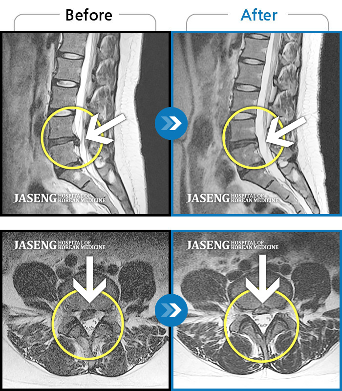 자생한방병원 치료사례 MRI로 보는 치료결과-우측 골반 통증과 다리 저림, 야간통