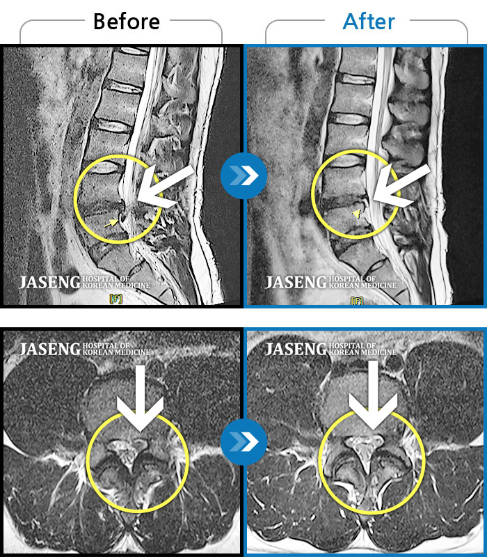 자생한방병원 치료사례 MRI로 보는 치료결과-좌측 허리부터 좌측 대퇴 후면까지 당기는 통증