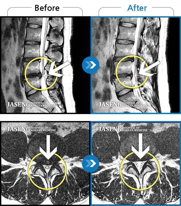 자생한방병원 치료사례 MRI로 보는 치료결과-좌측 하요추부 통증과 좌측 하지 전면 비증