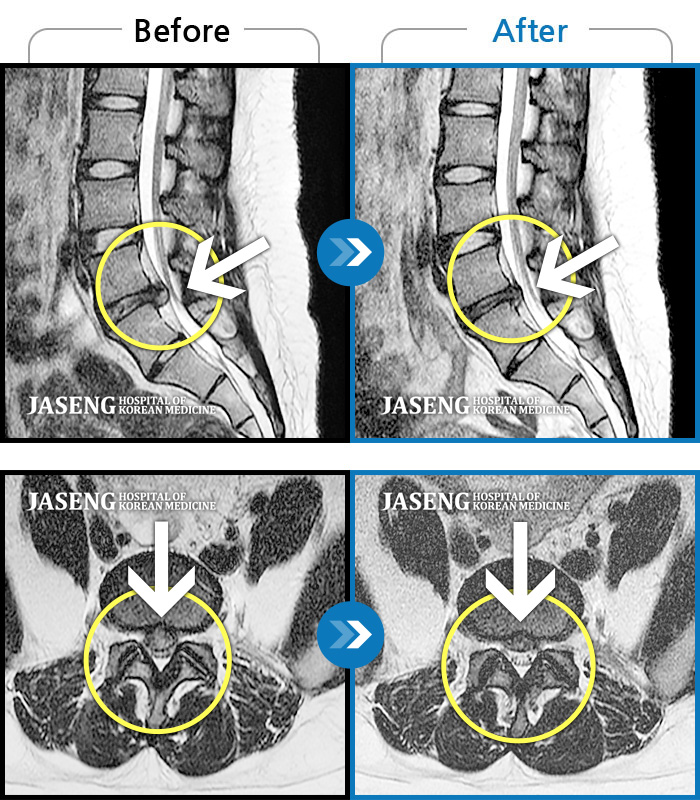 자생한방병원 치료사례 MRI로 보는 치료결과-허리 통증과 특히 왼쪽 하지 바깥쪽, 뒤쪽 통증