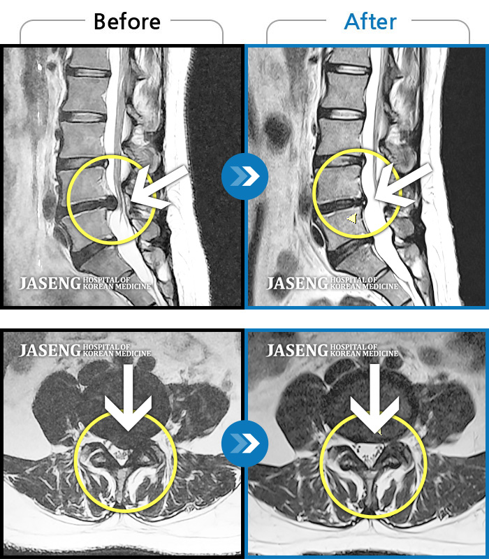 자생한방병원 치료사례 MRI로 보는 치료결과-허리 양측 골반 통증, 좌측 하지 통증과 비증 동반, 기립 시 종아리 당기는 증상