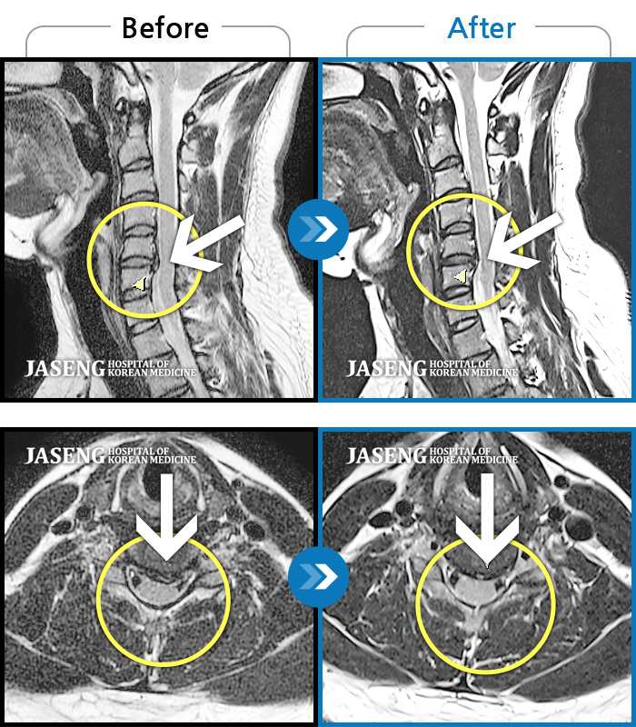 자생한방병원 치료사례 MRI로 보는 치료결과-양측 후경부에서 견갑골내연까지 이어지는 통증, 두통 증상