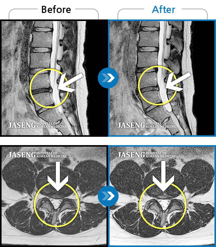 자생한방병원 치료사례 MRI로 보는 치료결과-디스크로 인한 좌측 하지 통증 재발