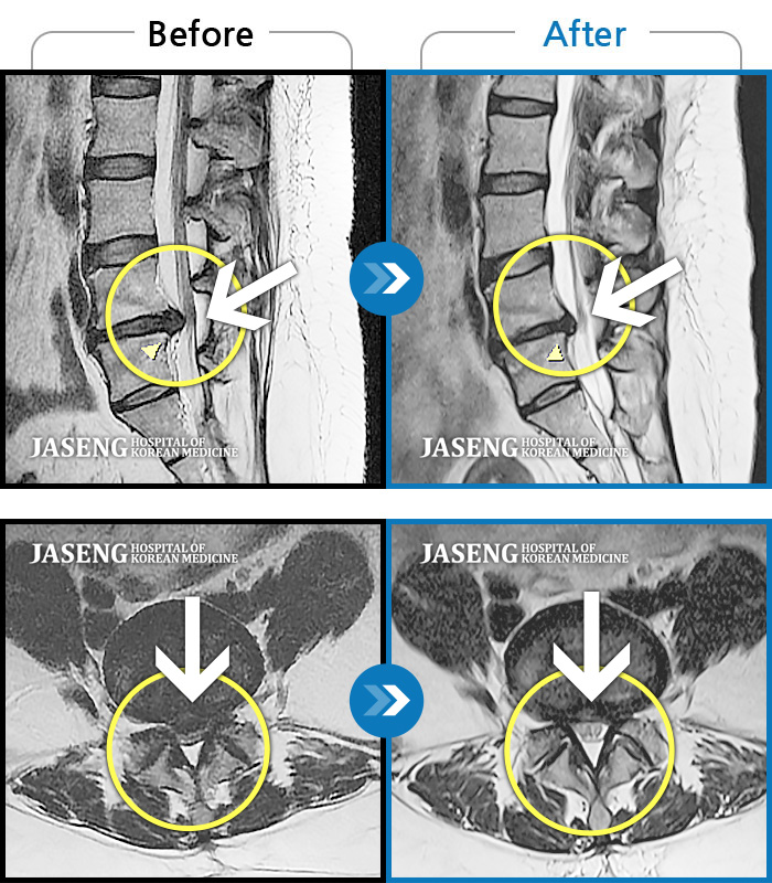 자생한방병원 치료사례 MRI로 보는 치료결과-허리 양측 통증, 우측 하지 비증으로 앉을 때 증상 심화 