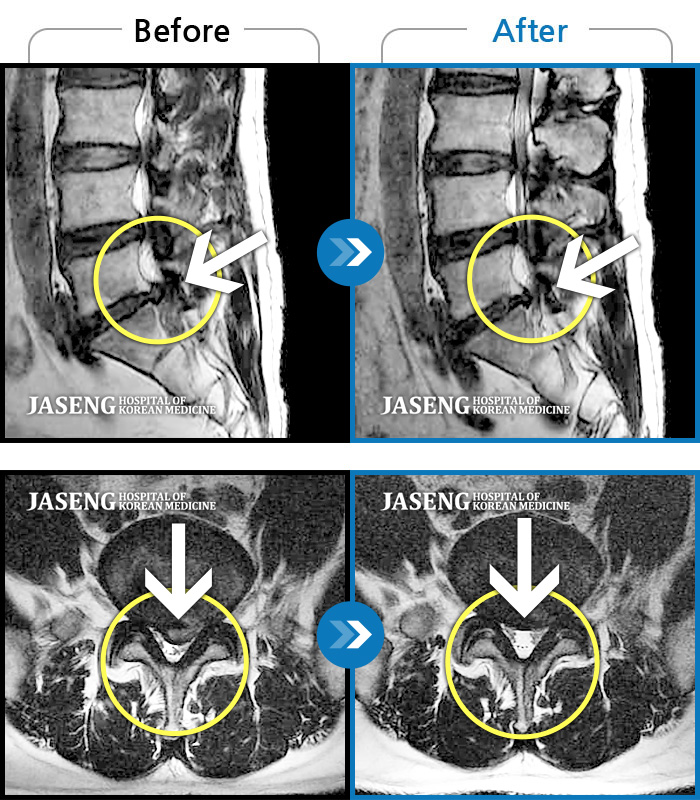 자생한방병원 치료사례 MRI로 보는 치료결과-양 엉치와 좌측 소퇴, 발등, 발목이 아프고, 발의 근력과 감각이 저하되었다.