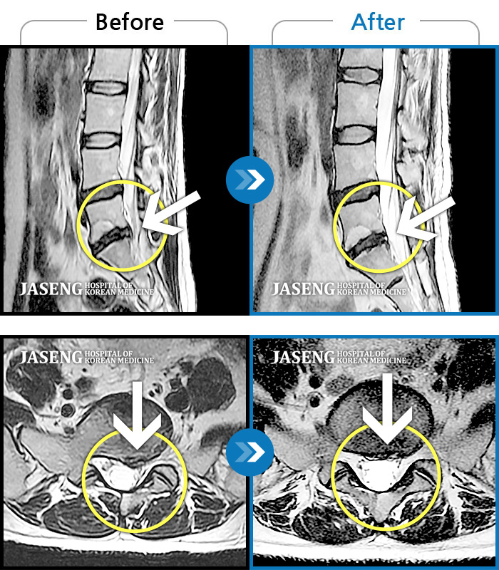 자생한방병원 치료사례 MRI로 보는 치료결과-허리통증과 좌측 엉치 및 꼬리뼈 까지의 심한 통증으로 일상생활의 어려움 호소