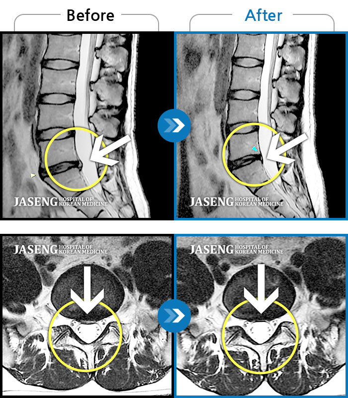 자생한방병원 치료사례 MRI로 보는 치료결과-양쪽 엉치와 골반이 아프면서 왼쪽 발가락 감각이 둔해졌다.