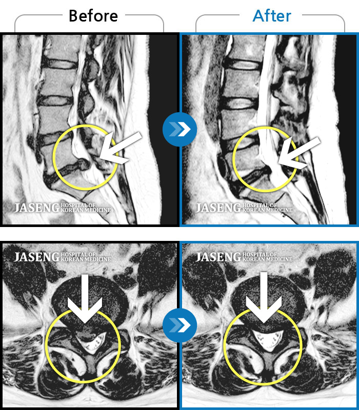 자생한방병원 치료사례 MRI로 보는 치료결과-허리에서 양측 골반, 다리까지 아픈데 오른쪽이 더 심하다.
