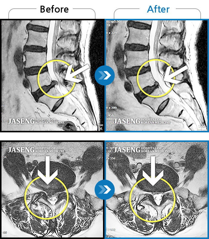 자생한방병원 치료사례 MRI로 보는 치료결과-서 있을때 아프고, 아침에 자고 일어나면 골반이 욱신욱신하게 아프고 다리가 아파요. 발 디딜때 마다 심하네요.