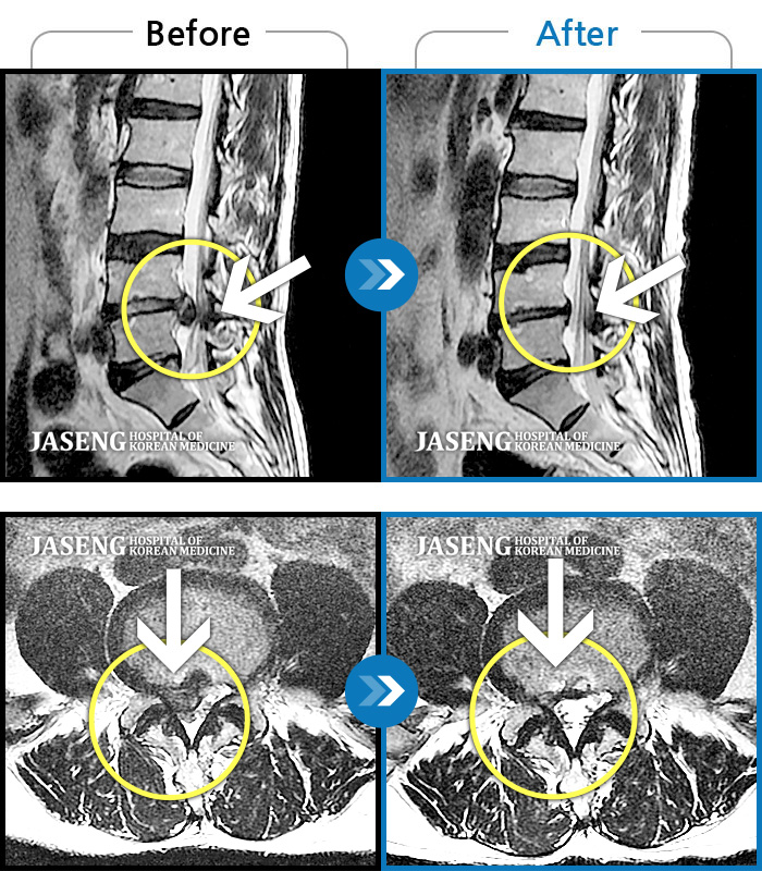 자생한방병원 치료사례 MRI로 보는 치료결과-허리 및 양쪽 골반에 심한통증으로 일주일간 거동이 불가능 했으며 우측 하지로 방사통이 심한 상태