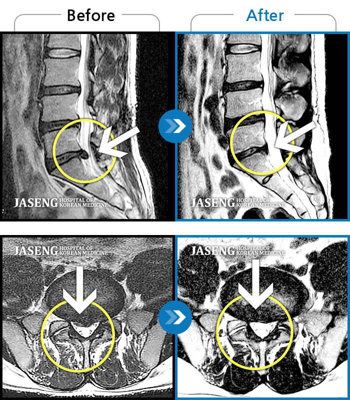 자생한방병원 치료사례 MRI로 보는 치료결과-허리 골반이 욱신욱신하게 아프고 우측 다리가 저렸다.
