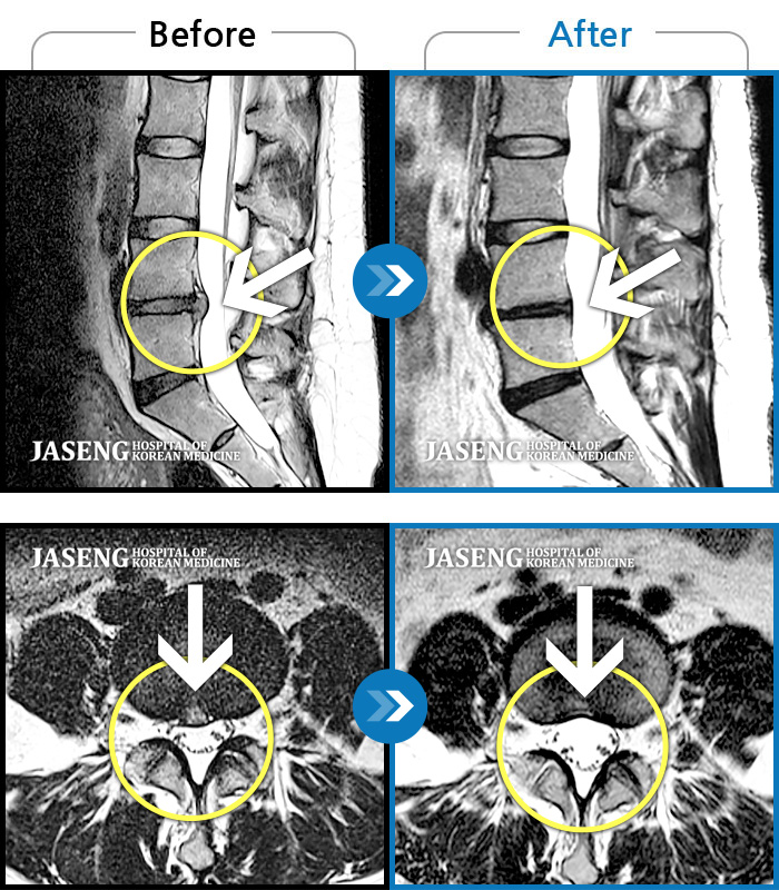 자생한방병원 치료사례 MRI로 보는 치료결과-첫째 출산후 시작된 허리의 심한 통증