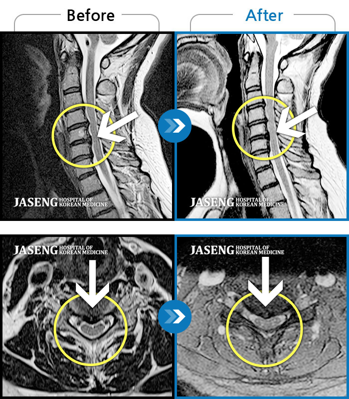 자생한방병원 치료사례 MRI로 보는 치료결과-목도 아프고 양팔도 저리고, 어지러움도 있어요.
