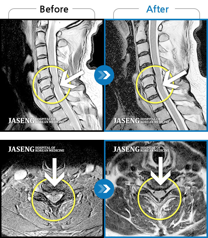 자생한방병원 치료사례 MRI로 보는 치료결과-왼쪽 목 통증과 함께 왼쪽 팔 전체가 아프고 손가락이 저리고 감각이 떨어짐.