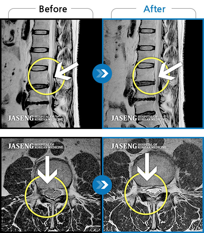 자생한방병원 치료사례 MRI로 보는 치료결과-허리 통증이 심하고 우측 다리가 많이 저리고 종아리 안쪽이 감각이 무뎠다.