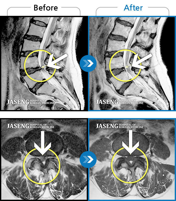 자생한방병원 치료사례 MRI로 보는 치료결과-하요추부 통증과 좌측 하지 외측 저림