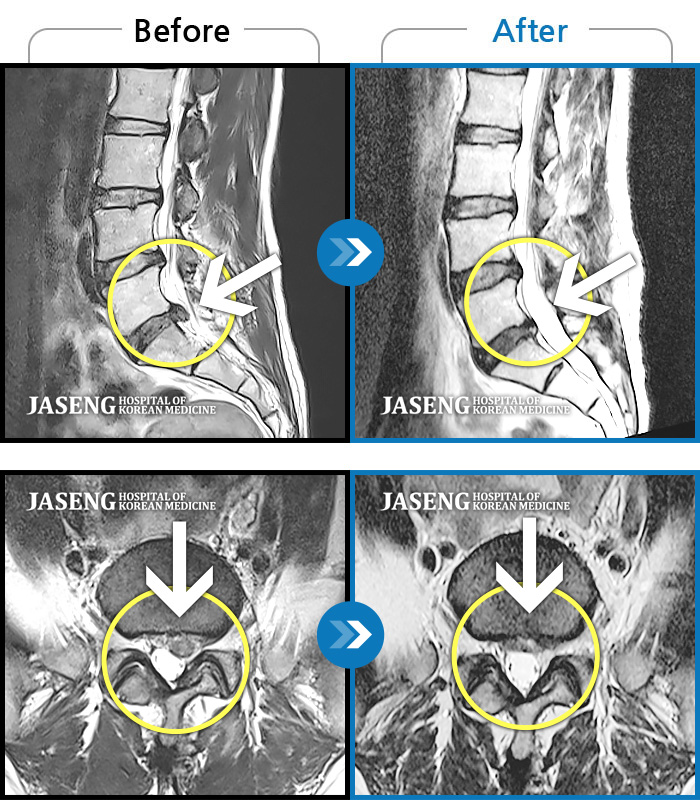 자생한방병원 치료사례 MRI로 보는 치료결과-좌측 엉치부터 하지 후면으로 통증이 매우 심하고, 좌측 족부에 쥐가 심하게 났다. 