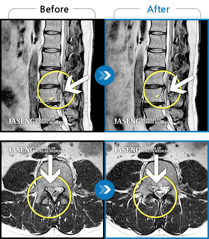 자생한방병원 치료사례 MRI로 보는 치료결과-허리 양측부터 골반까지 뻐근한 통증, 좌위 시, 보행 시 통증 심화 