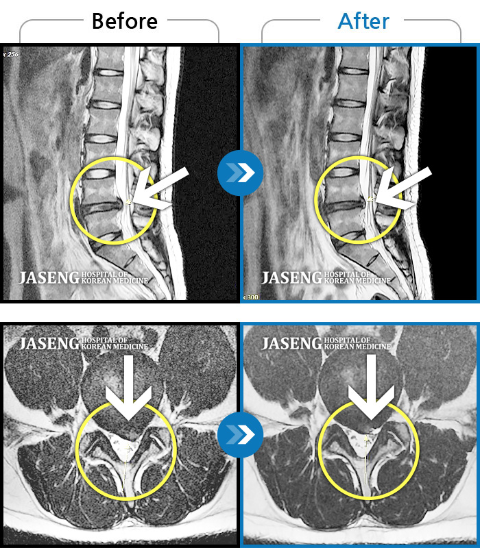 자생한방병원 치료사례 MRI로 보는 치료결과-좌측 소퇴 후면 비증/통증