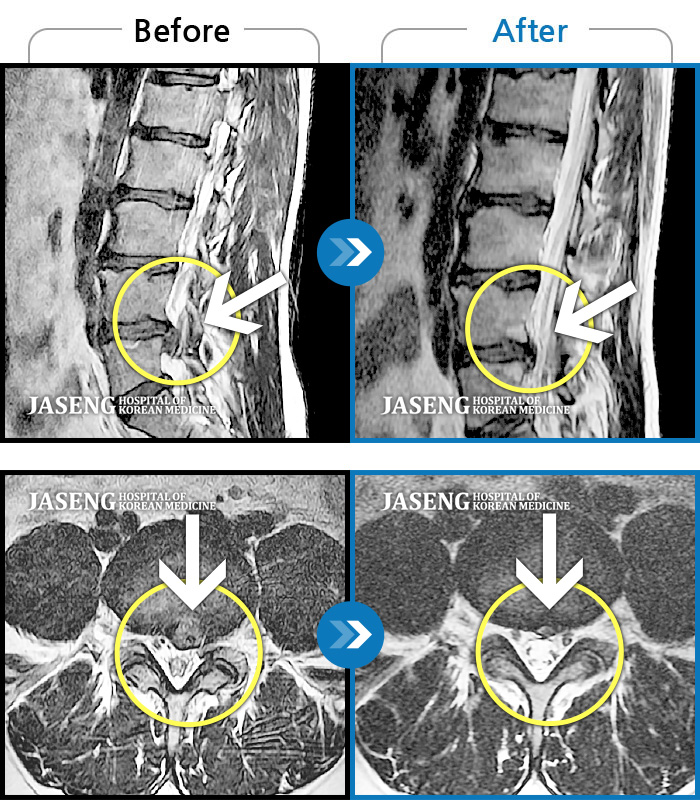 자생한방병원 치료사례 MRI로 보는 치료결과-허리 통증과 심한 좌측 다리 통증으로 꼼짝도 할 수 없었다