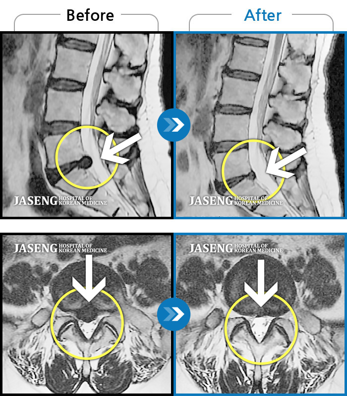 자생한방병원 치료사례 MRI로 보는 치료결과-허리부터 왼쪽 엉치, 종아리 뒤 쪽까지 저리고 아파서 걸을 수가 없어 구급차타고 내원했다.