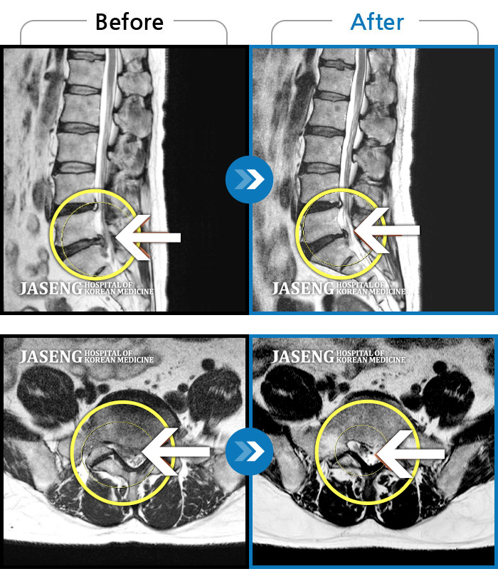 자생한방병원 치료사례 MRI로 보는 치료결과-통증과 다리 저림이 심해서 거동이 안되어 입원했어요.