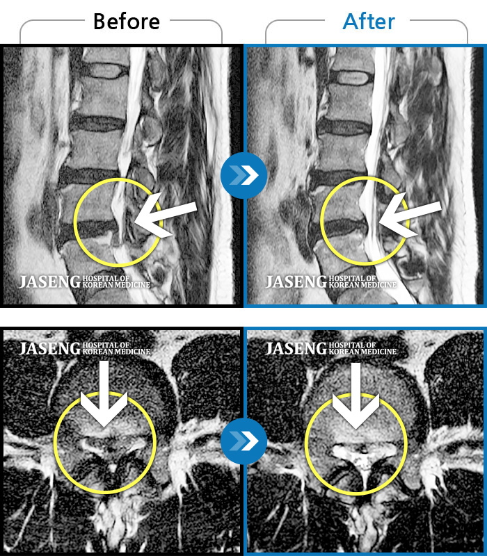 자생한방병원 치료사례 MRI로 보는 치료결과-처음 내원 시 허리부터 우측 골반까지 통증이 심해 일상생활이 매우 힘든 상태로 내원하셨습니다. 