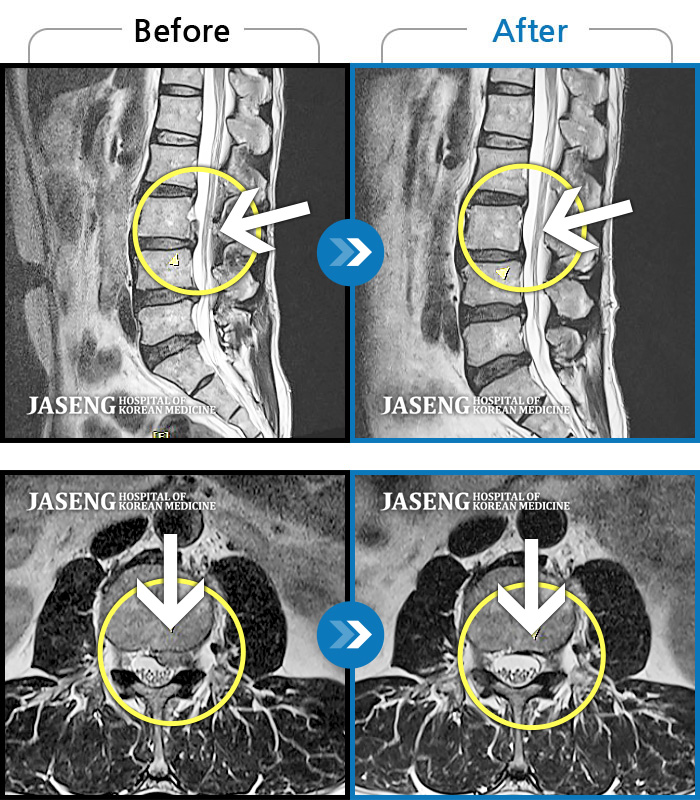 자생한방병원 치료사례 MRI로 보는 치료결과-허리 양측부터 골반까지 묵직한 통증, 좌측 하지 후면으로 이어지는 당기는 통증