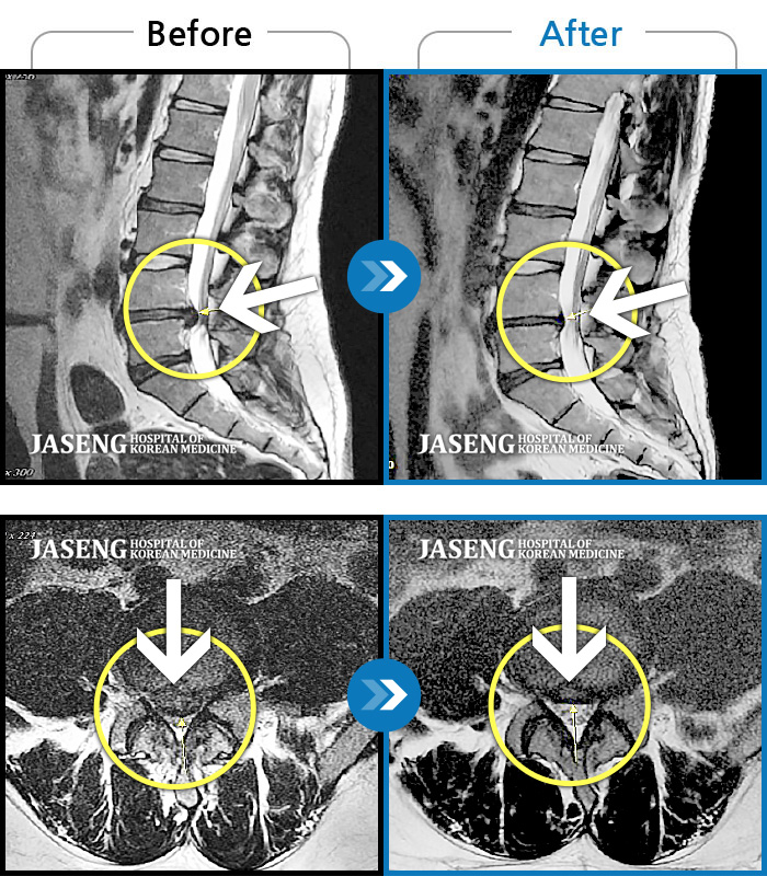 자생한방병원 치료사례 MRI로 보는 치료결과-요추부 통증/우측 둔부~대퇴 후면 당김 감